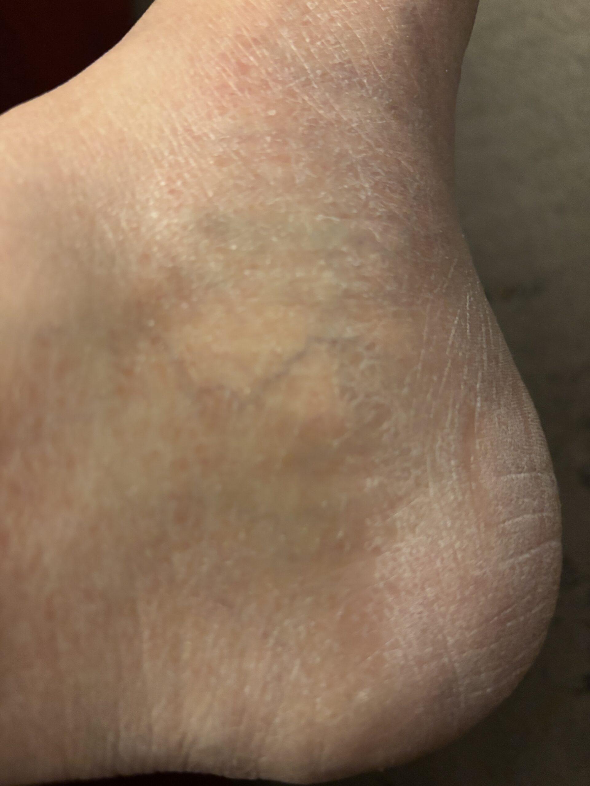 Example of Diabetic Foot before Moisturizer
